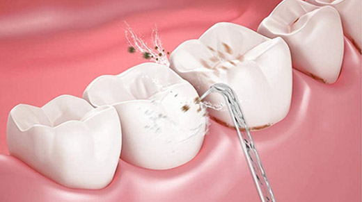 irrigador dental para implantes